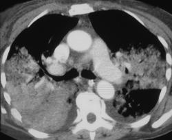 Alveolar Cell Carcinoma - CTisus CT Scan