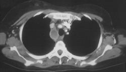 Bronchogenic Cyst - CTisus CT Scan