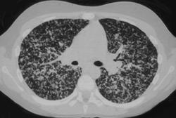 Miliary Tuberculosis (TB) - CTisus CT Scan