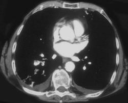 Pe - CTisus CT Scan
