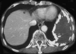 Old Emphyema - CTisus CT Scan