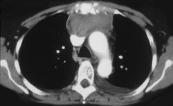 Mediastinal Hematoma (post-op) - CTisus CT Scan