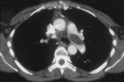 Pe - CTisus CT Scan