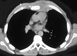 Recurrent Lymphoma in the Chest Wall - CTisus CT Scan