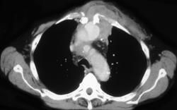 Pseudoaneurysm Off Subclavian Artery - CTisus CT Scan