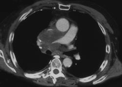 Small Cell Lung Cancer With SVC Syndrome - CTisus CT Scan