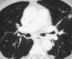 Lung Metastases and Intrabronchial Lesion Secondary to Metastatic Colon Cancer - CTisus CT Scan