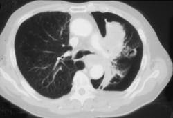 Lung Cancer With Nodes - CTisus CT Scan