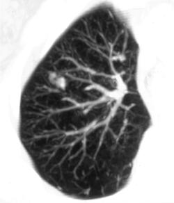 3D of Early Lung Cancer - CTisus CT Scan