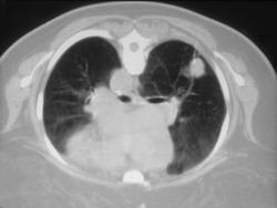 Lung Biopsy - CTisus CT Scan