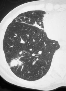 Scar Lung Cancer - CTisus CT Scan