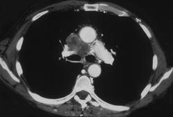 SVC Occlusion- Small Cell Lung Cancer - CTisus CT Scan