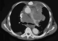 Lung Cancer Invades/infiltrates the Heart - CTisus CT Scan