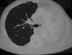 Lung Cancer Invading Airway - CTisus CT Scan