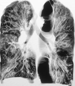 Cystic Fibrosis - CTisus CT Scan