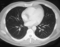 Lung Nodule Only Seen With 3mm Spacing - CTisus CT Scan