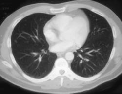 Lung Nodule Only Seen With 3mm Spacing - CTisus CT Scan