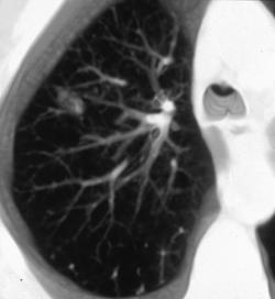 Lung Nodule - CTisus CT Scan