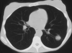 Lung Cancer Simulates An Arteriovenous Malformation (AVM) - CTisus CT Scan