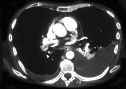 Pulmonary Embolism and Splenic Infarct - CTisus CT Scan