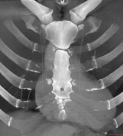 Normal Variant Sternum - CTisus CT Scan