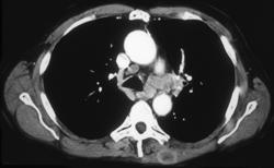Ap Window Nodes Due to Lung Cancer With Muscle Metastases in Left Paraspinal Muscles - CTisus CT Scan
