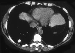 Calcified Right Lower Lung Nodules - CTisus CT Scan