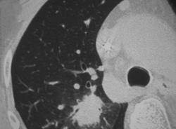 RVL Nodule Which With the Correct Hx Will Be Inflammatory - CTisus CT Scan