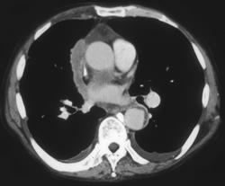 Tumor Implants on Pericardium Lung Cancer By Hx - CTisus CT Scan