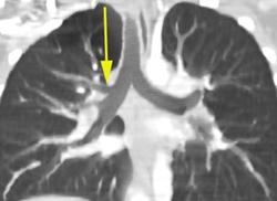 Tracheal Bronchus With Hyperinflation of Rt. Upper Lung - CTisus CT Scan