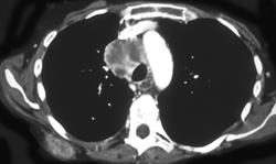 Lung Cancer With Muscle Metastases - CTisus CT Scan