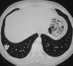 Pulmonary Arteriovenous Malformation (AVM) (right Lung) - CTisus CT Scan