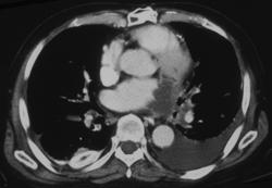 Lung Cancer Invades the Left Atrium - CTisus CT Scan