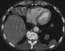 Cystic Right Paracardiac Nodes and Lung Metastases-renal Cell Carcinoma - CTisus CT Scan
