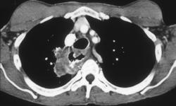 Achalasia With Secondary Carcinoma Invades the Lung - CTisus CT Scan