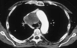 Small Cell Lung Cancer With Liver Metastases - CTisus CT Scan