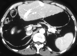 Hypervascular Lung and Liver Metastases From Renal Cell Cancer - CTisus CT Scan
