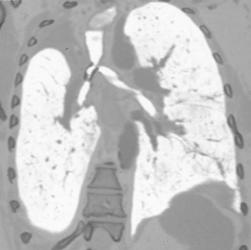 Lung Cancer With Stent in Airway - CTisus CT Scan