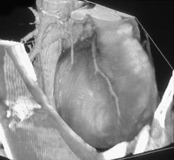 Coronary Arteries - CTisus CT Scan
