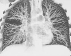 Nice 3D of Fissure in the Right Lung - CTisus CT Scan