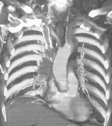 SVC Occlusion Due to Lung Cancer - CTisus CT Scan