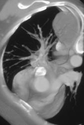 Lung Cancer Erodes the Spine - CTisus CT Scan
