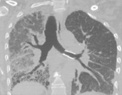 Stent in Airway (prior Left Lung Transplant) - CTisus CT Scan