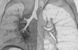 Hyperinflation of the Left Lung Due to Airway Occlusion - CTisus CT Scan
