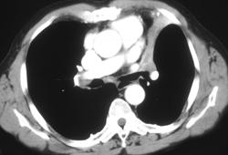 Small Cell Lung Cancer With Left Upper Lobe Collapse - CTisus CT Scan