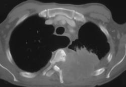 Lung Cancer Invades Spine and Chest Wall - CTisus CT Scan