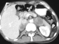 Lung Cancer Invades Spine and Bilateral Adrenal Metastases - CTisus CT Scan