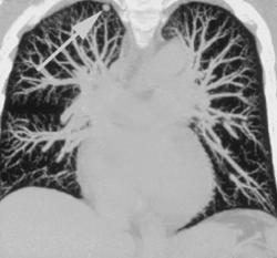 3D Lung With 1 Cm Right Upper Lung Nodule - CTisus CT Scan