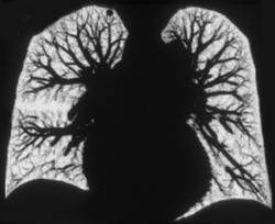 Lung Nodule in 3D - CTisus CT Scan