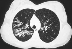 Cystic Fibrosis - CTisus CT Scan